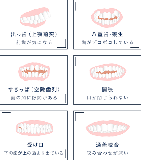 前歯が気になる/歯がデコボコしている/歯の間に隙間がある/口が閉じられない/下の歯が上の歯より出ている/咬み合わせが深い