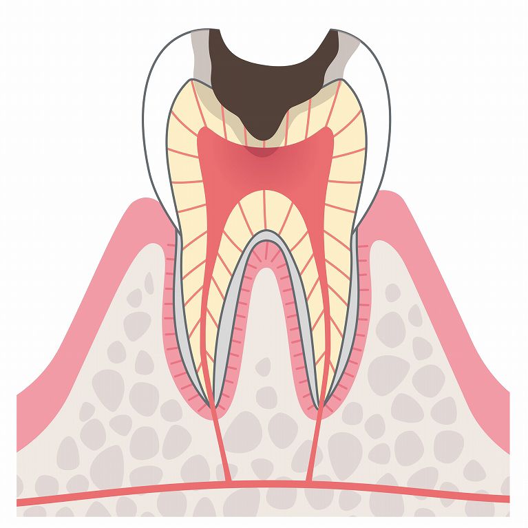 C3（神経まで達した虫歯）