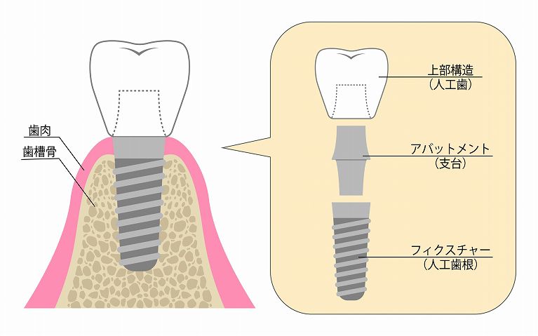 インプラントはどんな治療？？