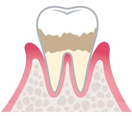 軽度歯周病