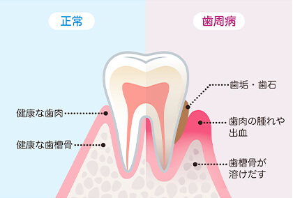 歯周組織再生療法